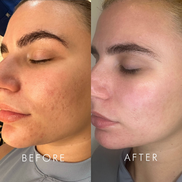 Resurface & Heal Before and after
