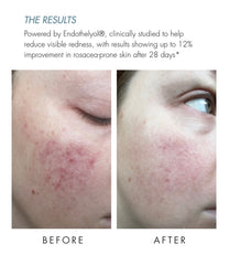 Rosacea Duo